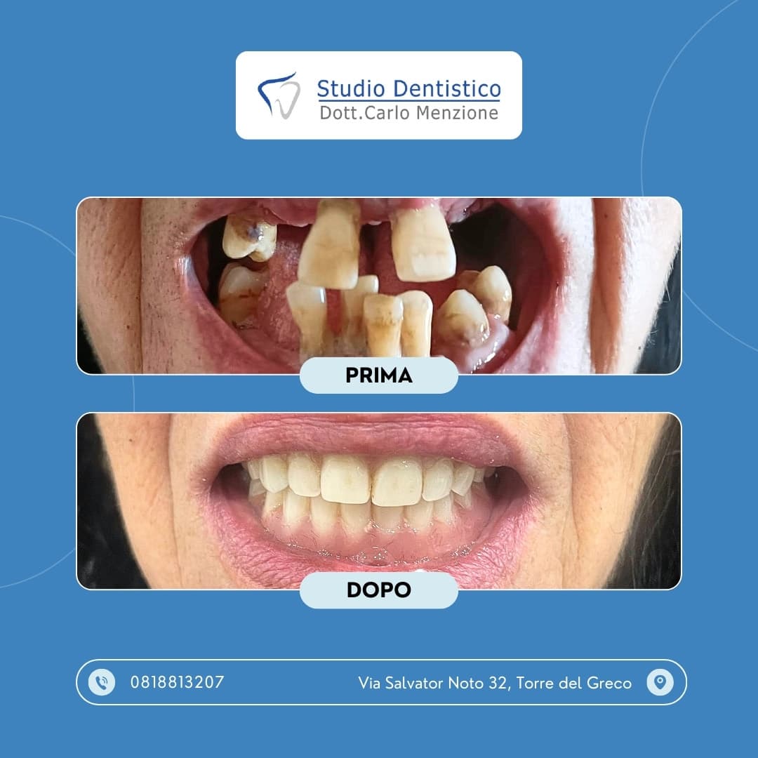 Lavoro odontoiatrico 2 — Studio Dentistico Carlo Menzione, Torre del Greco