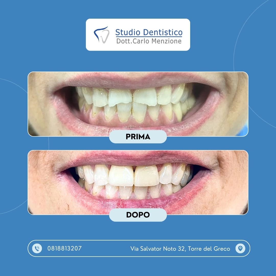 Lavoro odontoiatrico 3 — Studio Dentistico Carlo Menzione, Torre del Greco