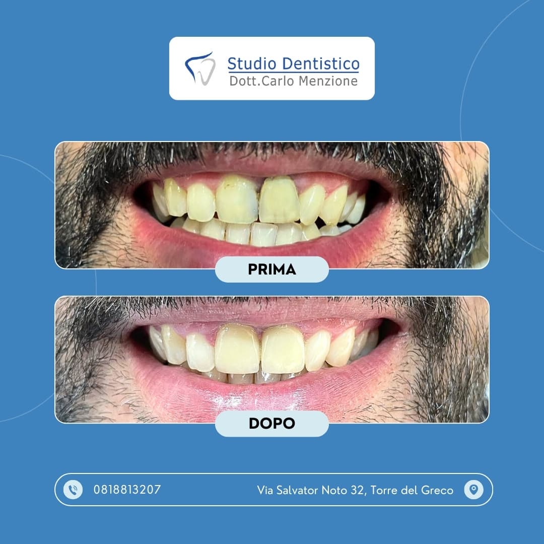 Lavoro odontoiatrico 4 — Studio Dentistico Carlo Menzione, Torre del Greco
