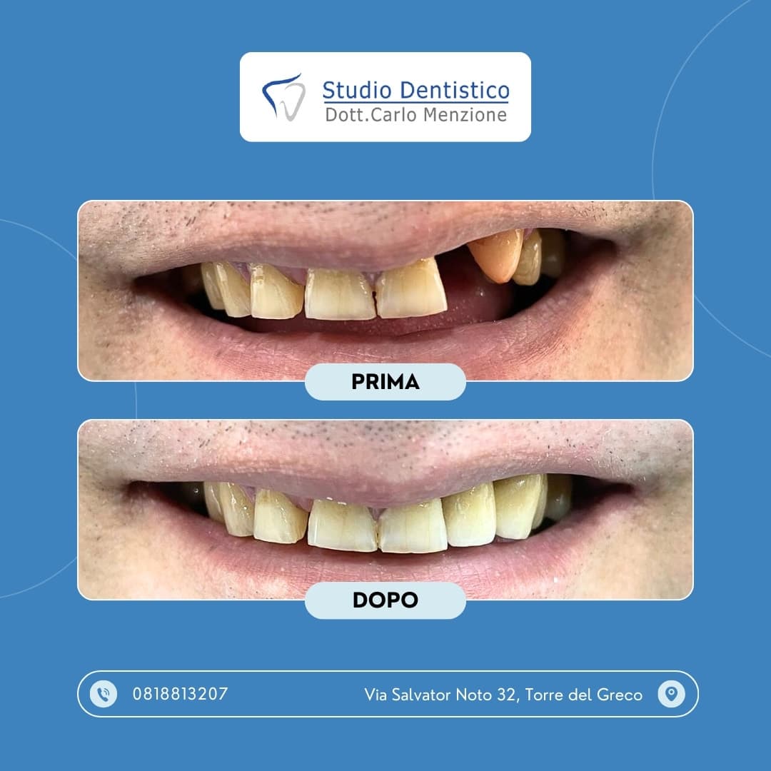 Lavoro odontoiatrico 5 — Studio Dentistico Carlo Menzione, Torre del Greco