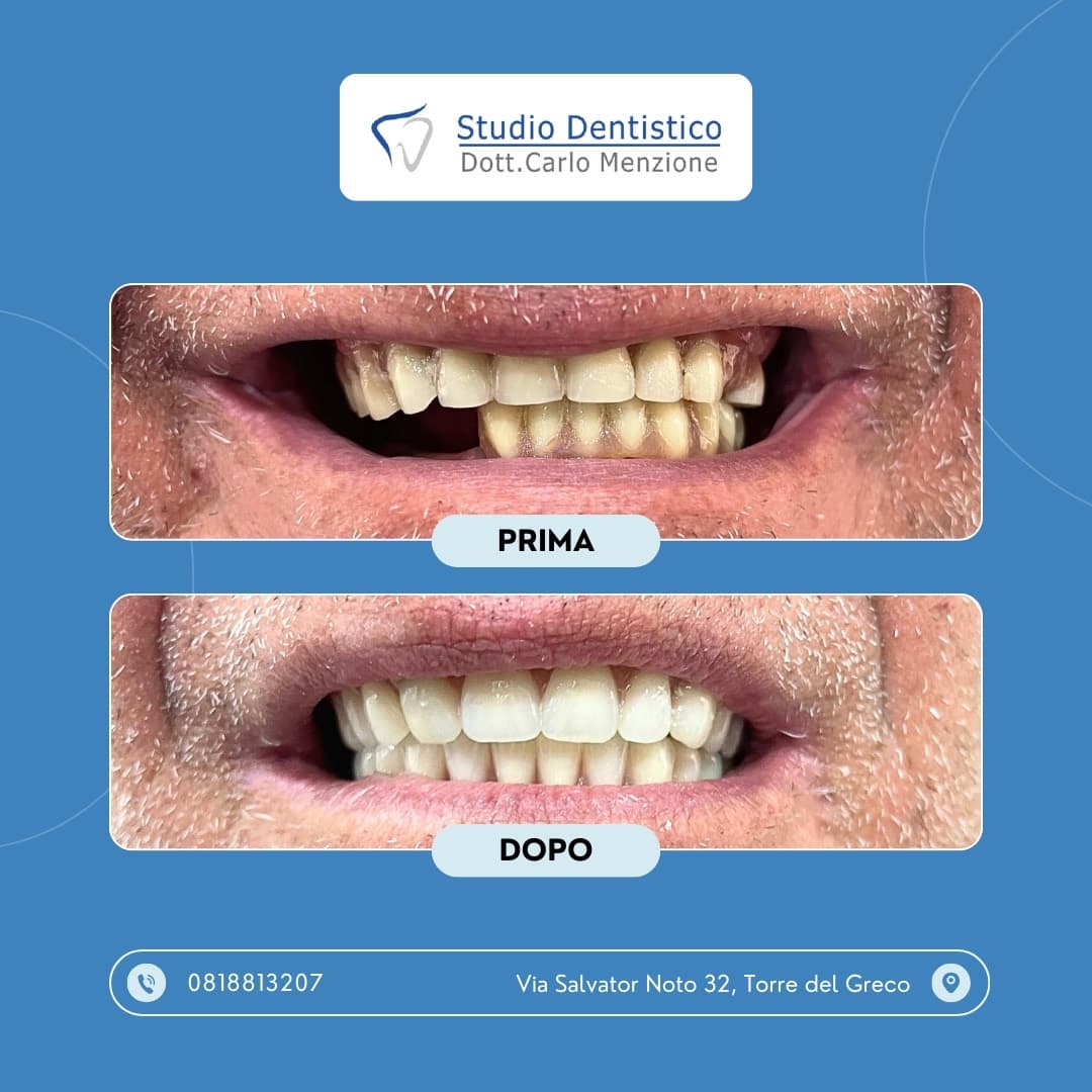Lavoro odontoiatrico 6 — Studio Dentistico Carlo Menzione, Torre del Greco