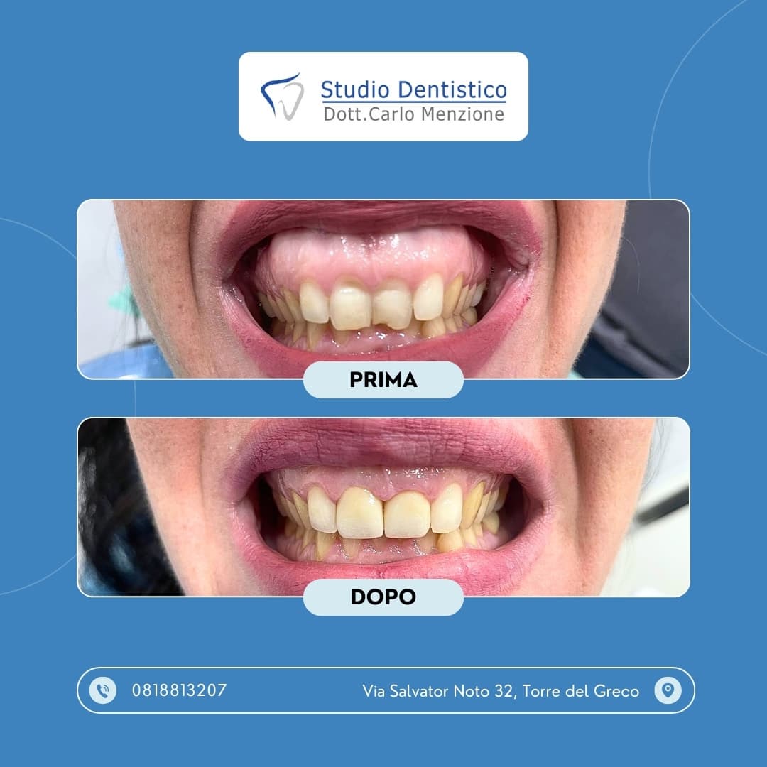 Lavoro odontoiatrico 7 — Studio Dentistico Carlo Menzione, Torre del Greco