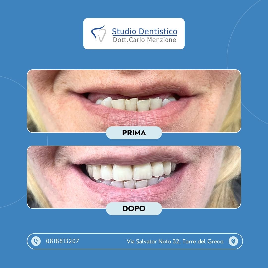 Lavoro odontoiatrico 8 — Studio Dentistico Carlo Menzione, Torre del Greco