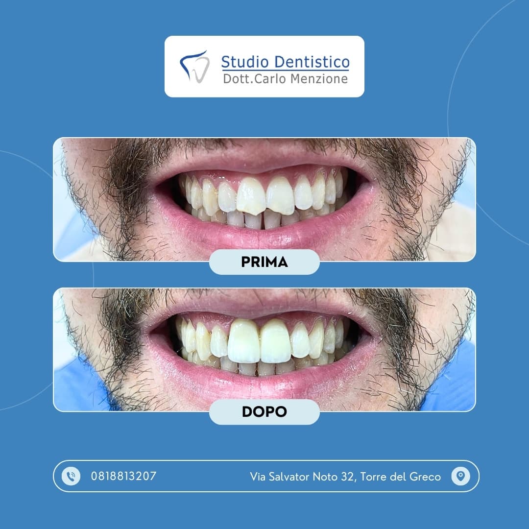 Lavoro odontoiatrico 9 — Studio Dentistico Carlo Menzione, Torre del Greco
