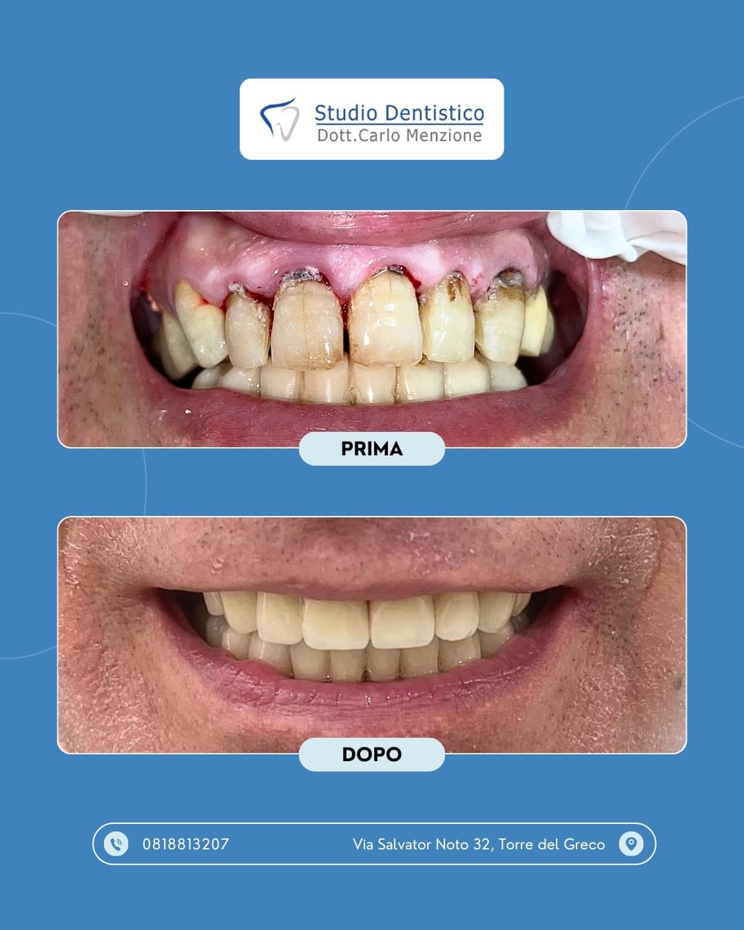 Lavoro odontoiatrico 11 — Studio Dentistico Carlo Menzione, Torre del Greco